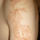 Illustration for article titled This is what your skin looks like after you've been struck by lightning